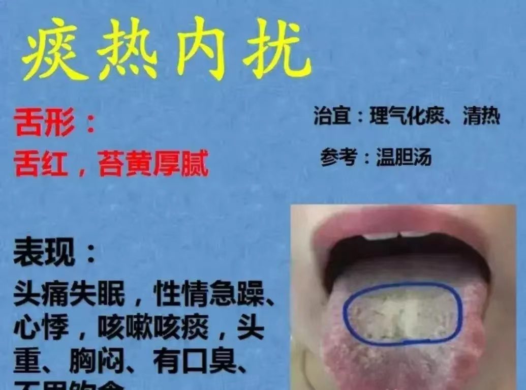 舌诊