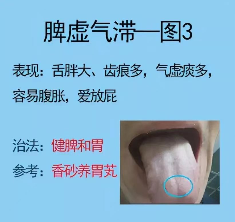舌诊